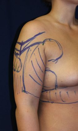 Arm Lift*/Arm Sculpting: Case 8 - Before