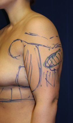 Arm Lift*/Arm Sculpting: Case 8 - Before