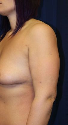 Arm Lift*/Arm Sculpting: Case 8 - After