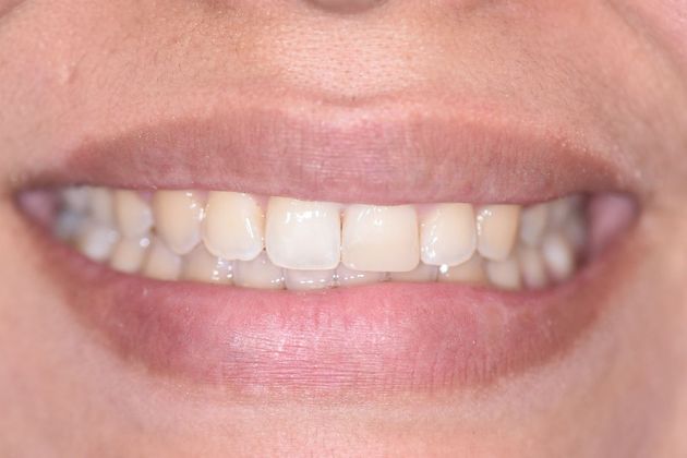 Invisalign Case 9 - Victoria, TX - After