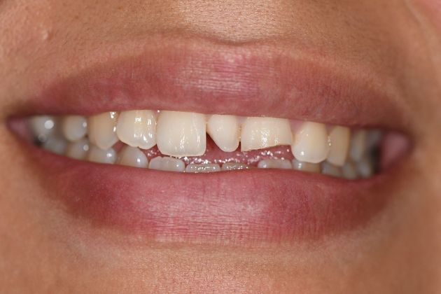 Invisalign Case 9 - Victoria, TX - Before