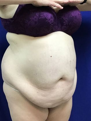 Body Tummy Tuck / Abdominoplasty: Case 23 - Before