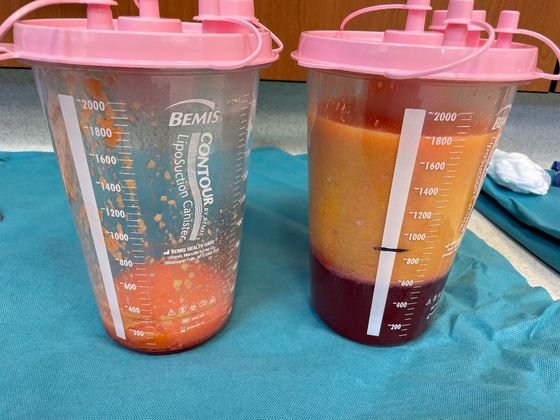 Body Tummy Tuck / Abdominoplasty: Case 23 - 1,400ml of fat removed by liposuction (flanks).