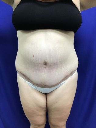 Body Tummy Tuck / Abdominoplasty Case 23  - After