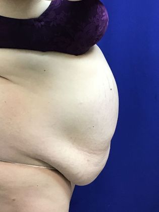 Body Tummy Tuck / Abdominoplasty: Case 23 - Before