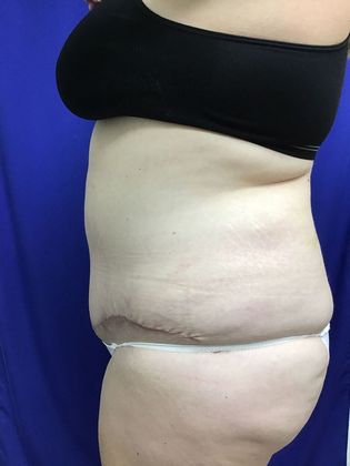 Body Tummy Tuck / Abdominoplasty: Case 23 - After, 2 months