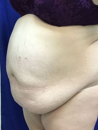 Body Tummy Tuck / Abdominoplasty: Case 23 - Before