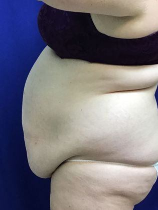 Body Tummy Tuck / Abdominoplasty: Case 23 - Before