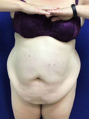 Body Tummy Tuck / Abdominoplasty Case 23  - Before