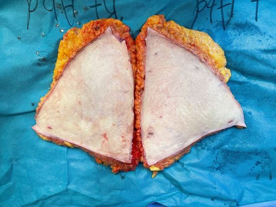 Body Tummy Tuck / Abdominoplasty: Case 23 - Skin & fat removed from the lower tummy.  Belly button site at the top midline.