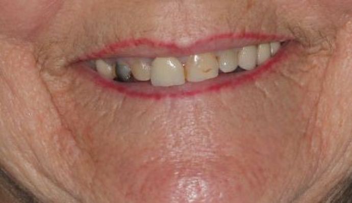 Dentures Case 6 - Before