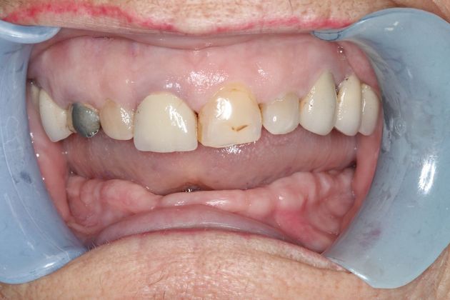 Dentures: Case 6 - Before