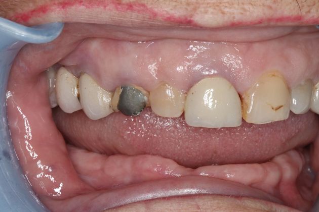 Dentures: Case 6 - Before