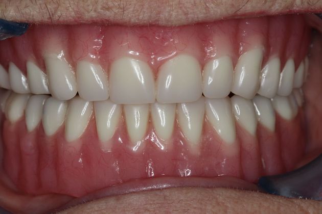Dentures: Case 6 - Upper and Lower Denture