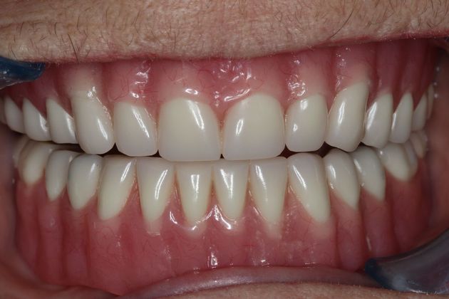 Dentures: Case 6 - Upper and Lower Denture