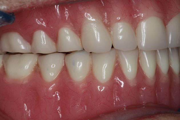 Dentures: Case 6 - After