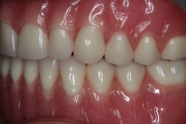 Dentures: Case 6 - Upper and Lower Denture
