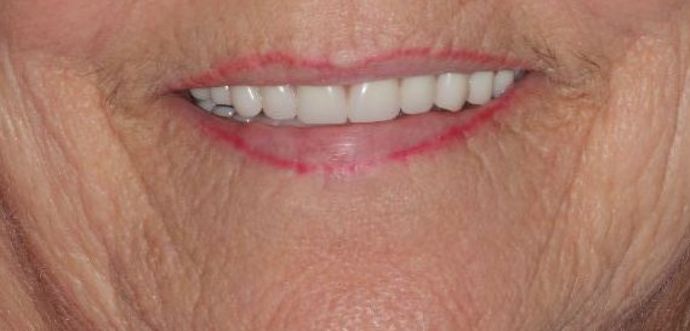 Dentures Case 6 - After