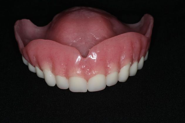 Dentures: Case 6 - Upper Denture