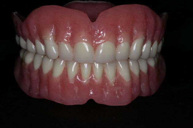 Dentures: Case 6 - Upper and Lower Denture