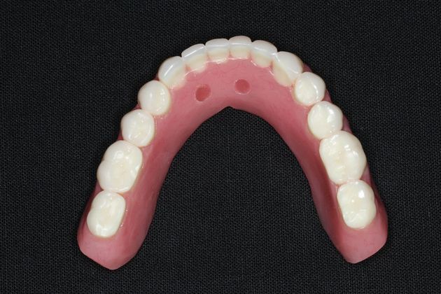 Dentures: Case 6 - Lower Locator Denture