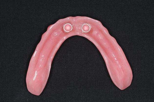 Dentures: Case 6 - Lower Locator Denture