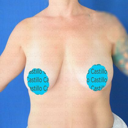 Breast Lift: Breast Lift + Breast Implants - Before