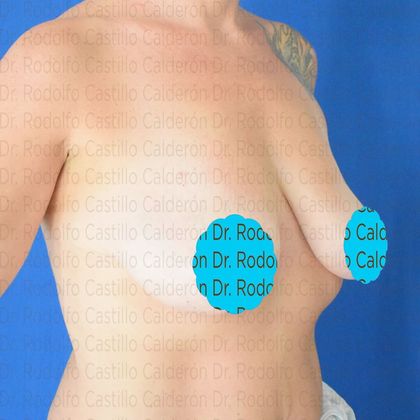 Breast Lift Breast Lift + Breast Implants - Before