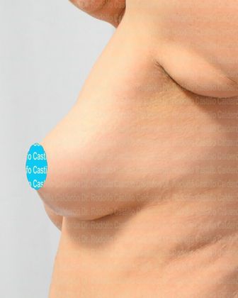 Breast Lift: Breast Lift + Breast Implants after massive weight loss - After 6 months