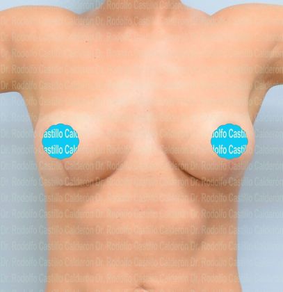 Breast Lift: Breast lift with lower volume implant change - After 1 year