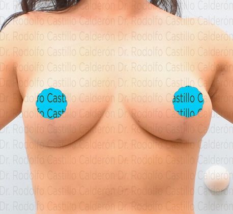 Breast Lift Breast lift with no implants - After