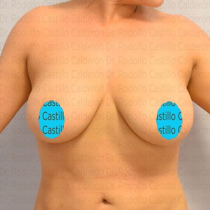 Breast Lift Breast lift with no implants - Before