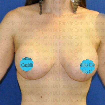 Breast Lift Breast Lift and implants post massive weight loss - After