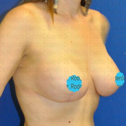 Breast Lift: Breast Lift and implants post massive weight loss - After