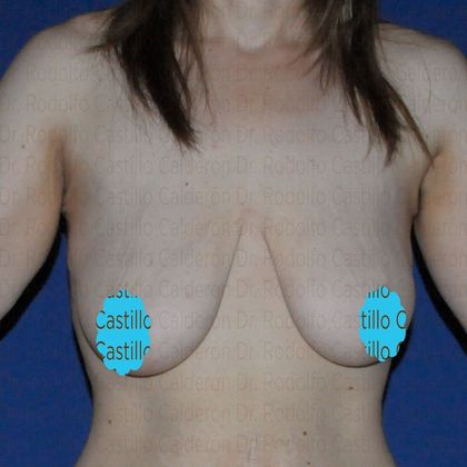 Breast Lift Breast Lift and implants post massive weight loss - Before
