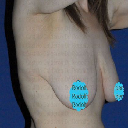 Breast Lift: Breast Lift and implants post massive weight loss - Before