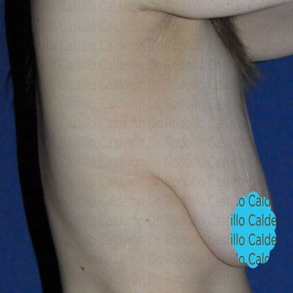 Breast Lift: Breast Lift and implants post massive weight loss - Before