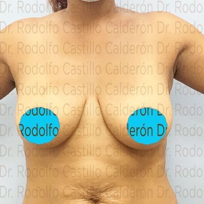 Breast Lift Breast lift with no implants in Mommy Makeover - Before