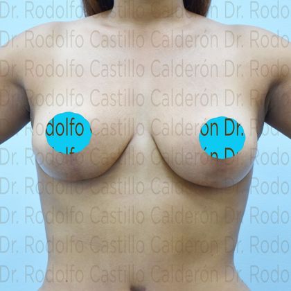 Breast Lift Breast lift with no implants in Mommy Makeover - After