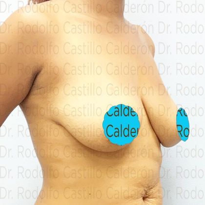 Breast Lift: Breast lift with no implants in Mommy Makeover - Before