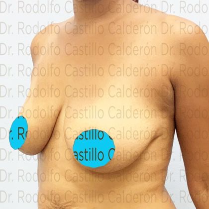 Breast Lift: Breast lift with no implants in Mommy Makeover - Before