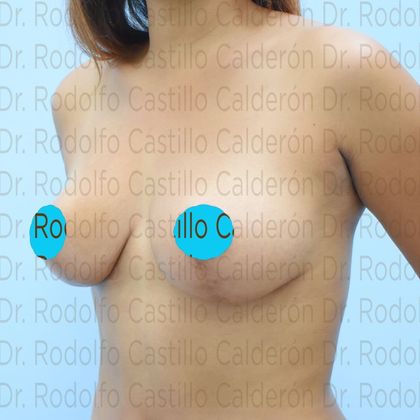 Breast Lift: Breast lift with no implants in Mommy Makeover - After 6 months