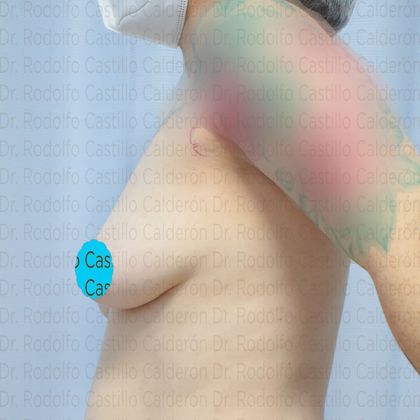 Breast Lift: Breast Lift + small implants - Before