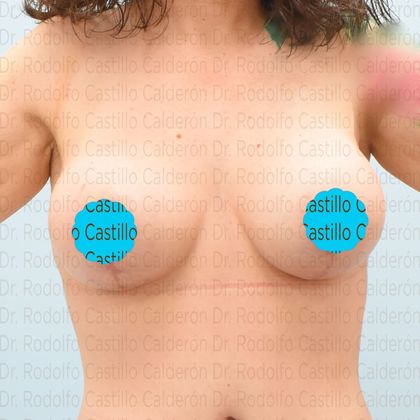 Breast Lift Breast Lift + small implants - After
