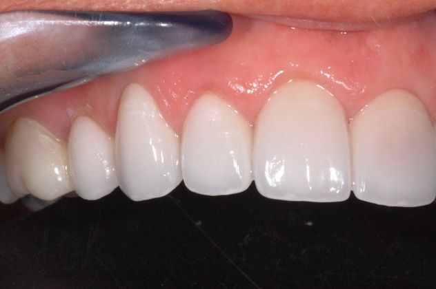 Porcelain-Ceramic Veneers for Cosmetic Dentistry: Replacement of 20 Year old Porcelain Veneers - Rt Side Outcome