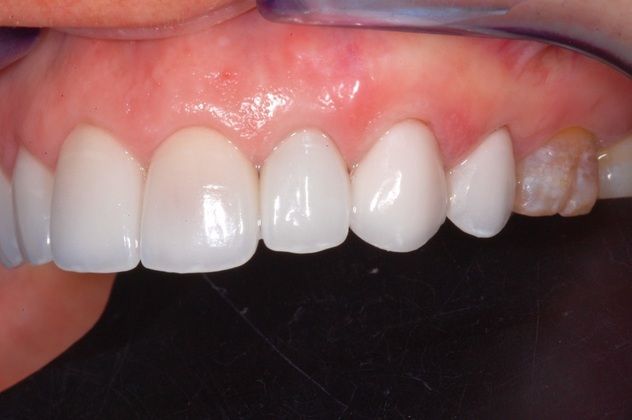 Porcelain-Ceramic Veneers for Cosmetic Dentistry: Replacement of 20 Year old Porcelain Veneers - Left Side Outcome