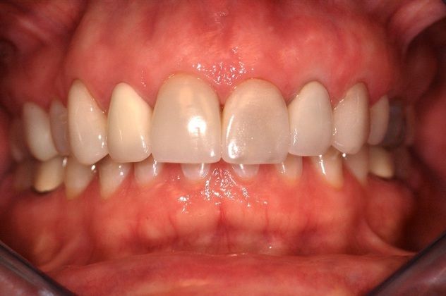 Porcelain-Ceramic Veneers for Cosmetic Dentistry: Replacement of 20 Year old Porcelain Veneers - Before