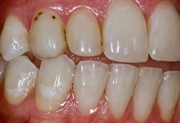 Smile Makeover Fix Ugly Composite Bonding -Black spots on bonding with micro leakage and recurrent decay-A limited smile makeover with Porcelain Veneers - Before