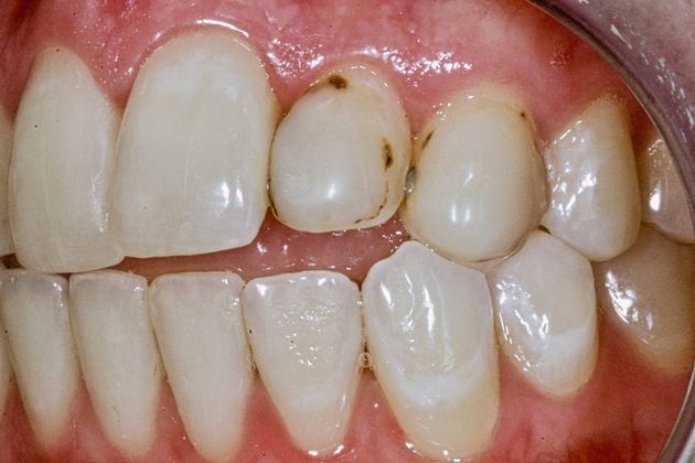Smile Makeover: Fix Ugly Composite Bonding -Black spots on bonding with micro leakage and recurrent decay-A limited smile makeover with Porcelain Veneers - Left Side Before
