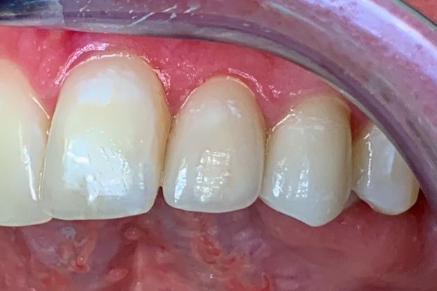 Smile Makeover: Fix Ugly Composite Bonding -Black spots on bonding with micro leakage and recurrent decay-A limited smile makeover with Porcelain Veneers - Right Side After